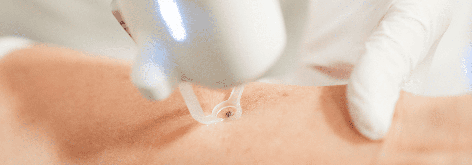 Lasermedizin - Übersicht 1 Behandlung mit Laser in Hautarztpraxis Haut & Herzlich