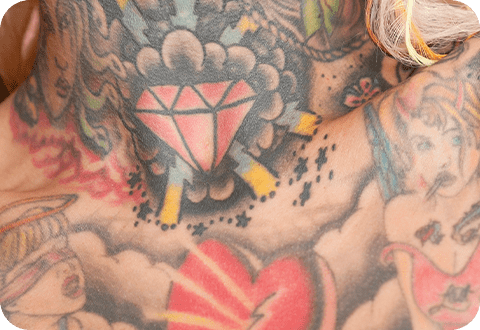 Tattoo vor der Entfernung