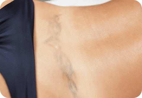 tattooentfernung 03