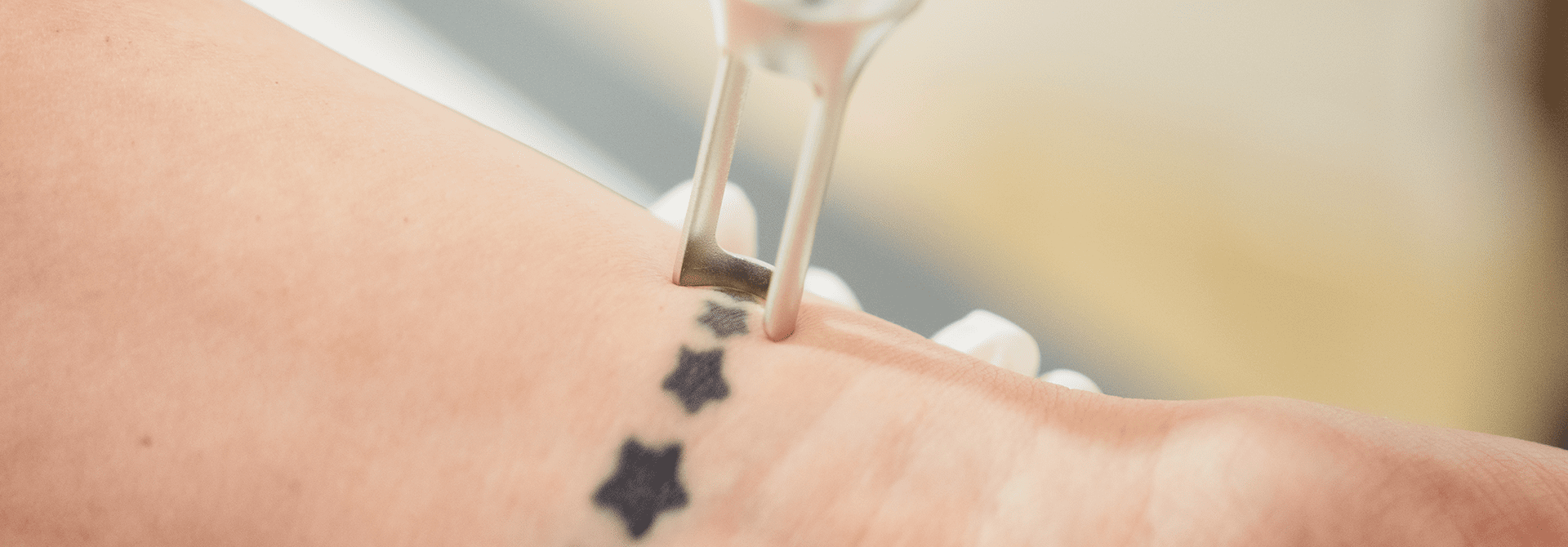 Laser Tattooentfernung Behandlung durch Dr. Elisabeth Stammler